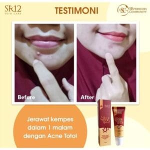 Acne Totol Tube 10 gr